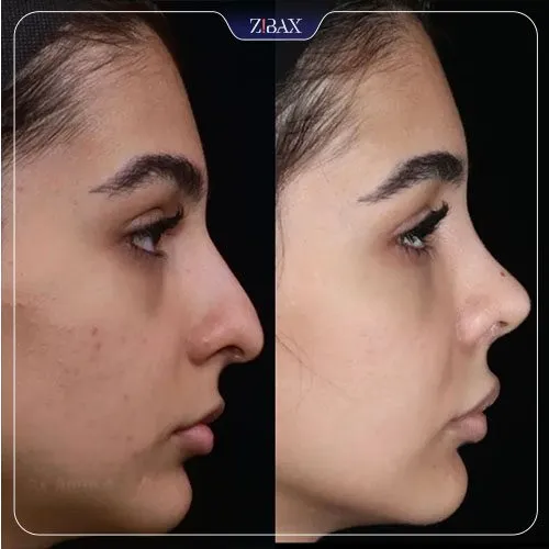 نمونه عمل جراحی بینی دکتر امین آمالی — تصویر 2