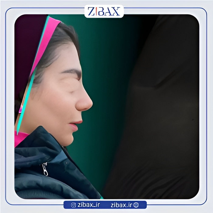نمونه عمل جراحی بینی دکتر عطاالله غفاری — تصویر 7