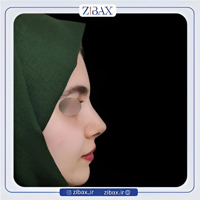نمونه عمل جراحی بینی دکتر عطاالله غفاری — تصویر 9
