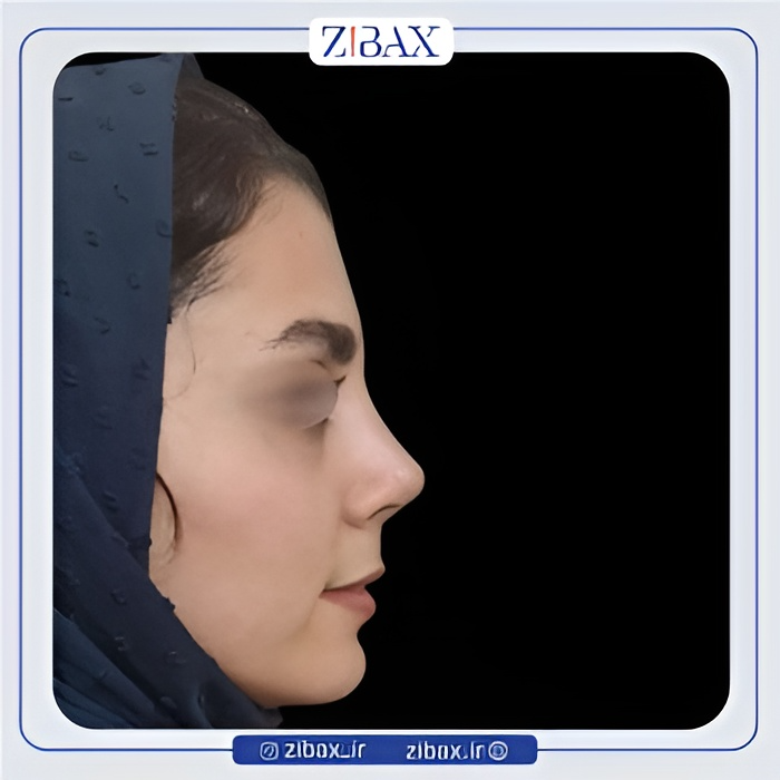 نمونه عمل جراحی بینی دکتر عطاالله غفاری — تصویر 10