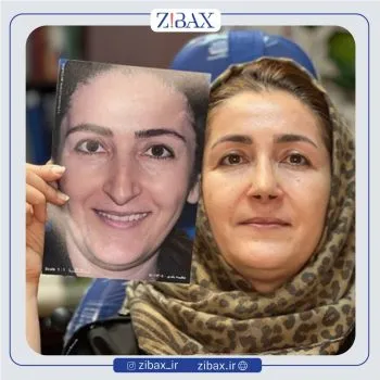 نمونه عمل جراحی بینی دکتر بهرام بادامچی — تصویر 7