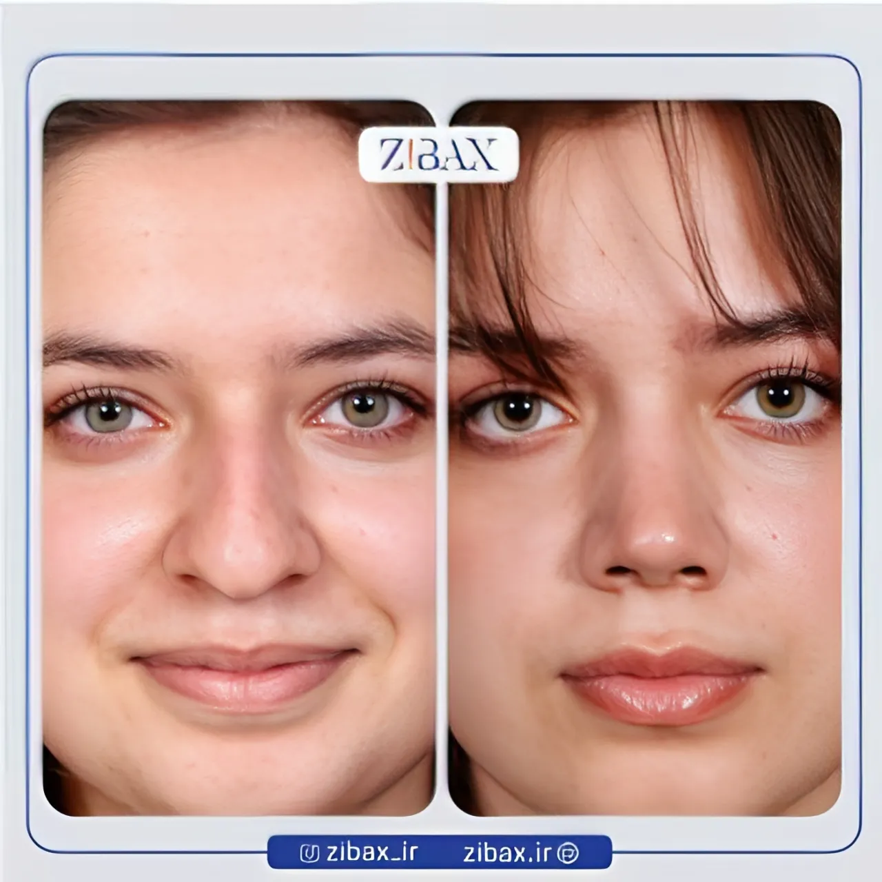 نمونه عمل جراحی بینی دکتر محمدباقر فتاحی — تصویر 2