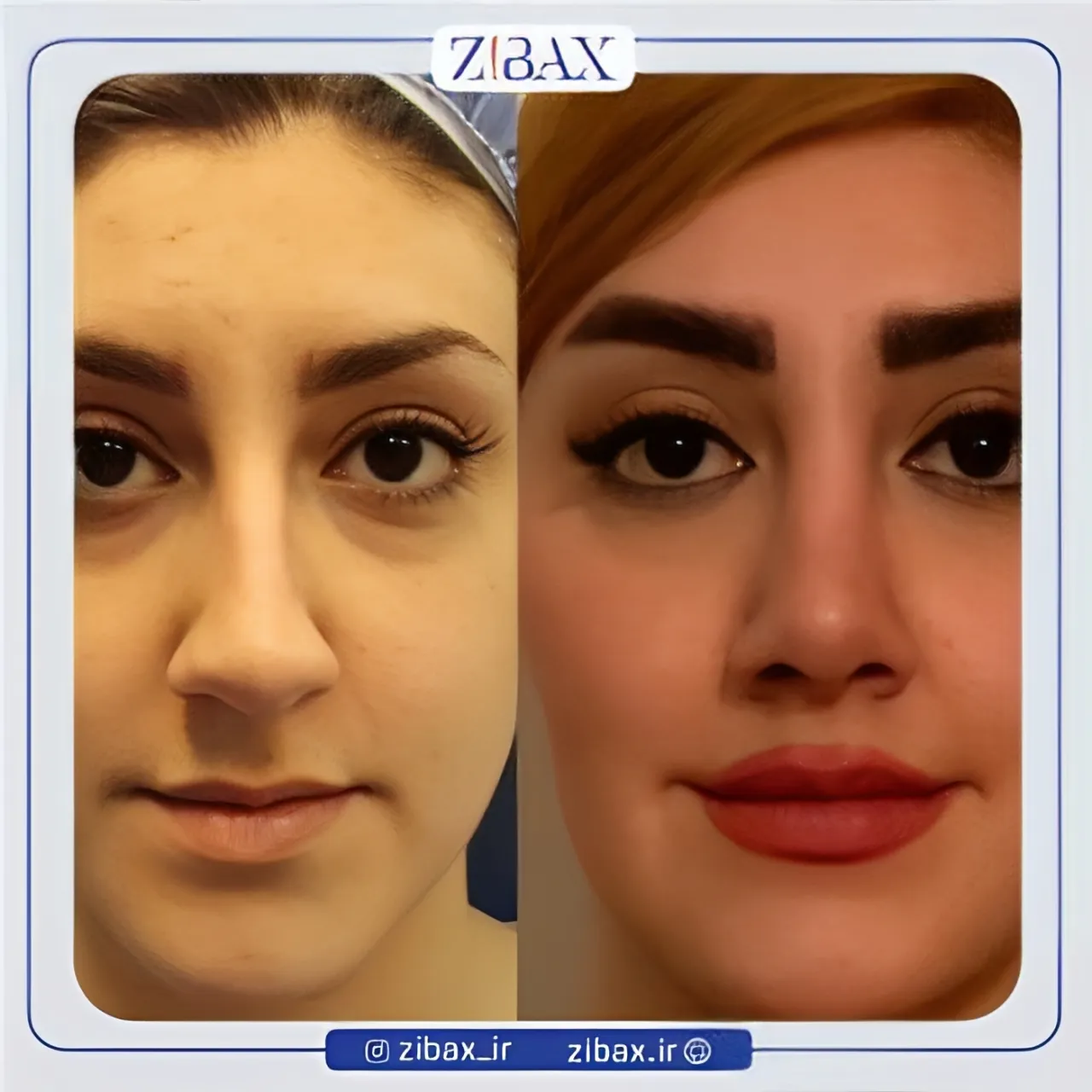 نمونه عمل جراحی بینی دکتر محمدباقر فتاحی — تصویر 3