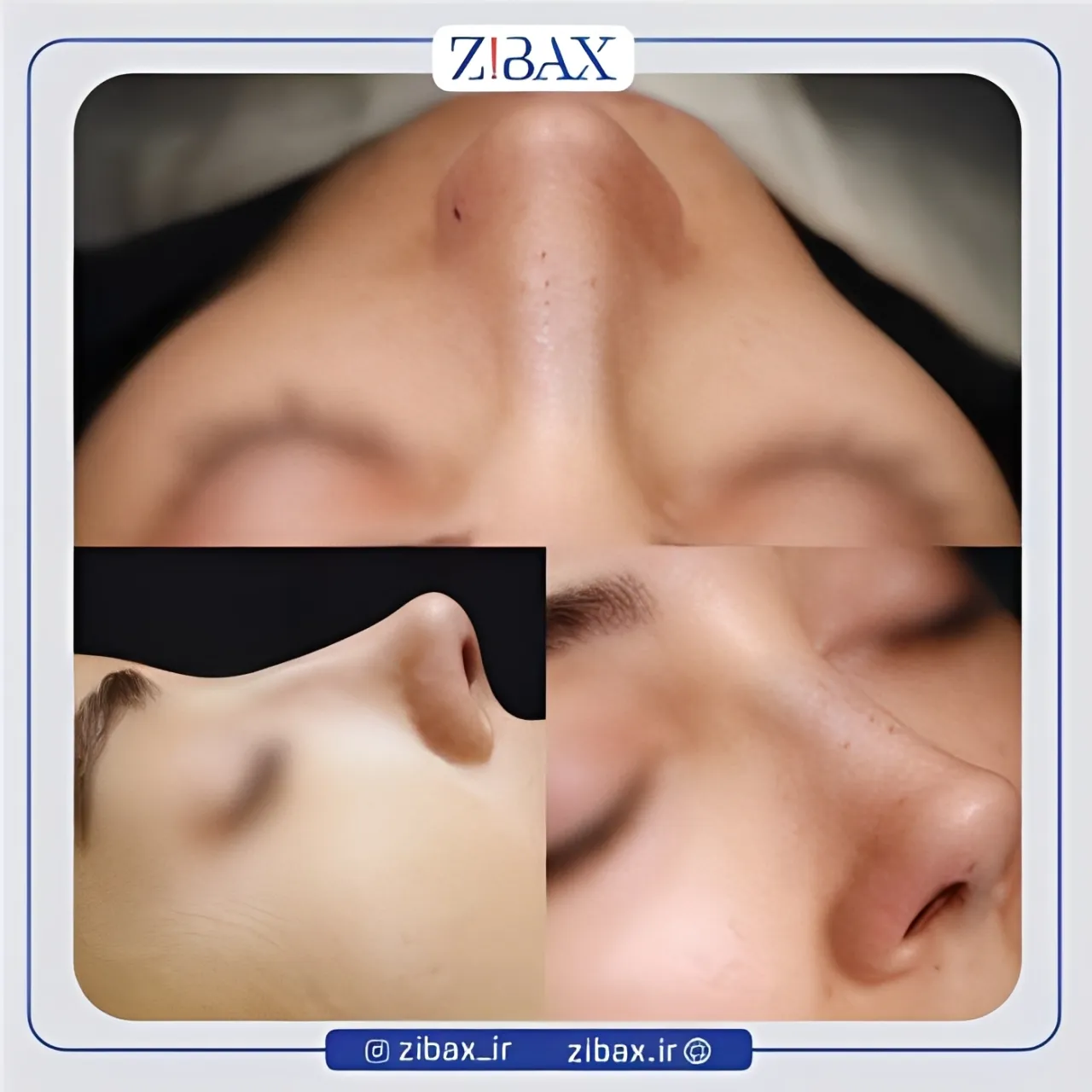 نمونه عمل جراحی بینی دکتر محمدباقر فتاحی — تصویر 9