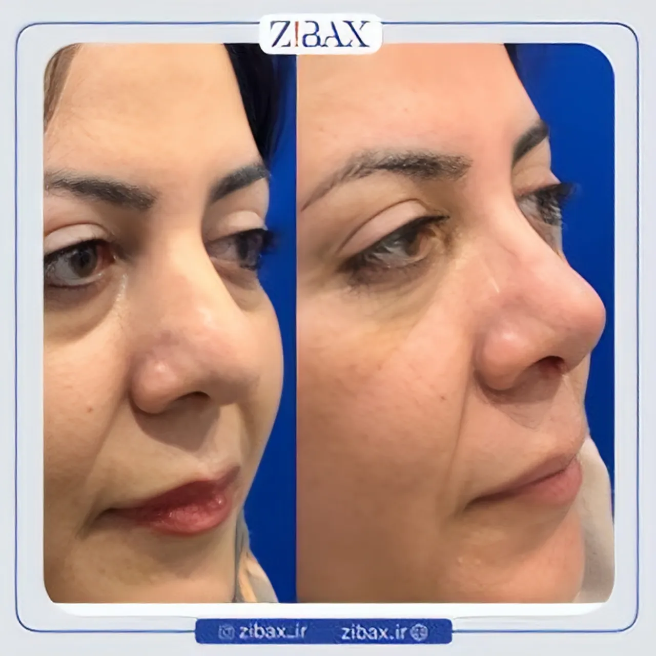 نمونه عمل جراحی بینی دکتر محمدباقر فتاحی — تصویر 10