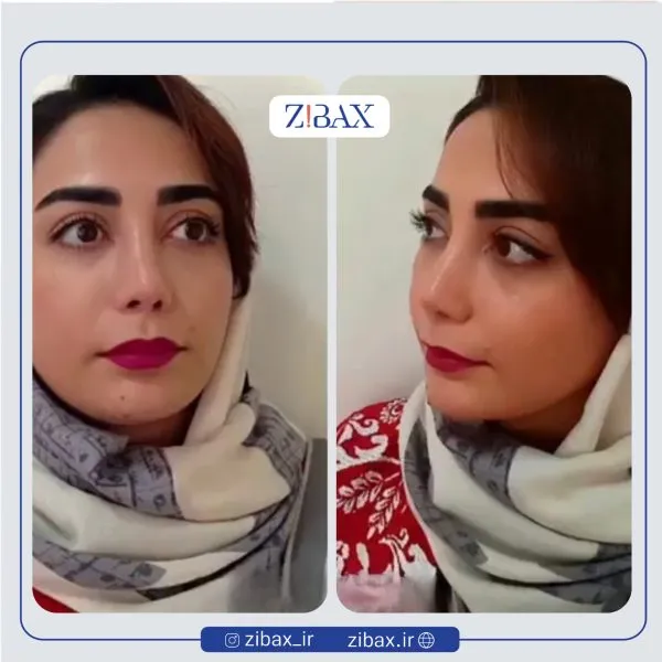 نمونه عمل جراحی بینی دکتر حمید مزارعی — تصویر 11