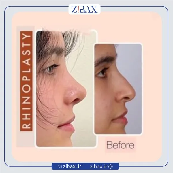 نمونه عمل جراحی بینی دکتر حمید مزارعی — تصویر 4