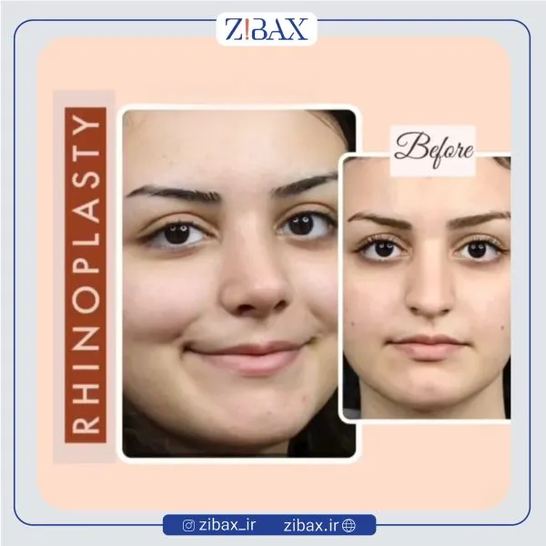نمونه عمل جراحی بینی دکتر حمید مزارعی — تصویر 5