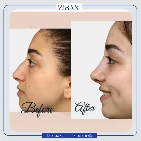 نمونه عمل جراحی بینی دکتر حمید مزارعی — تصویر 7