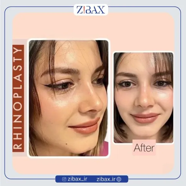 نمونه عمل جراحی بینی دکتر حمید مزارعی — تصویر 9