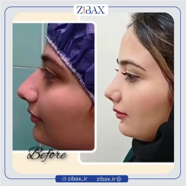 نمونه عمل جراحی بینی دکتر حمید مزارعی — تصویر 10