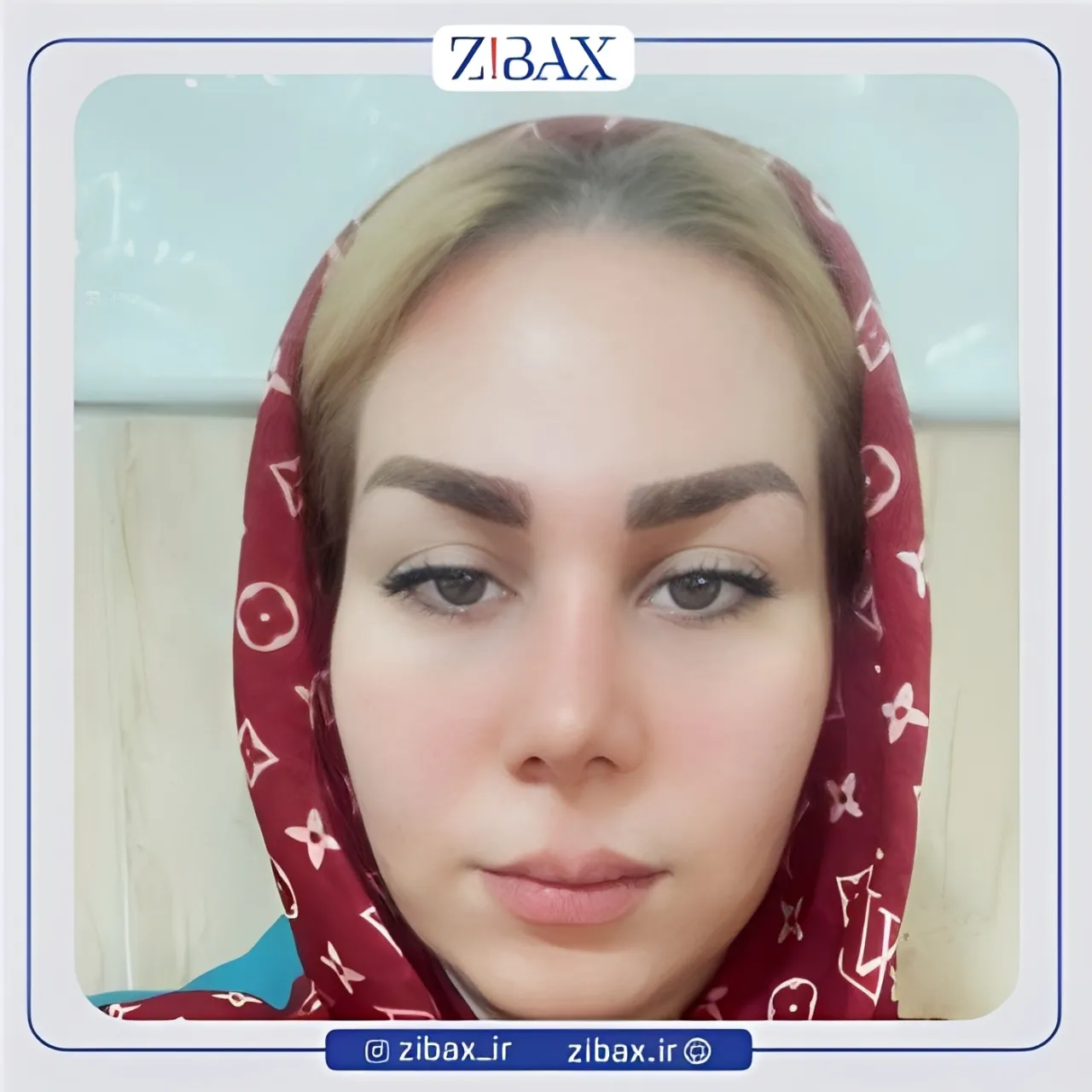 نمونه عمل جراحی بینی دکتر حسن فیروزی — تصویر 8