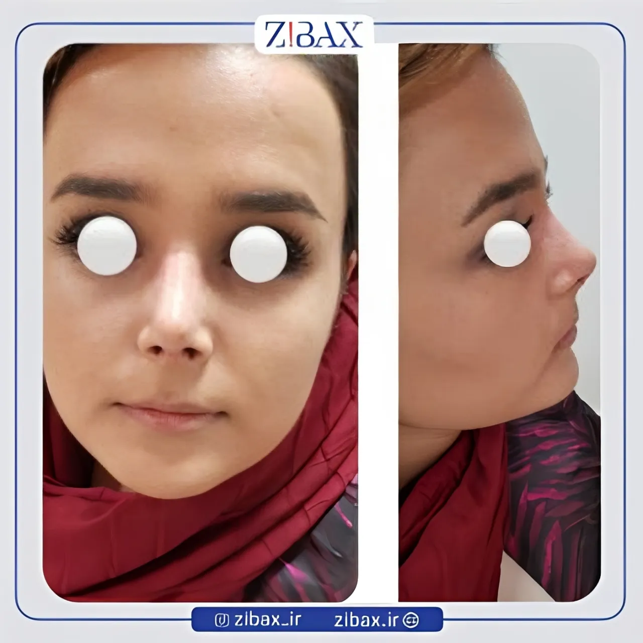 نمونه عمل جراحی بینی دکتر حسن فیروزی — تصویر 1