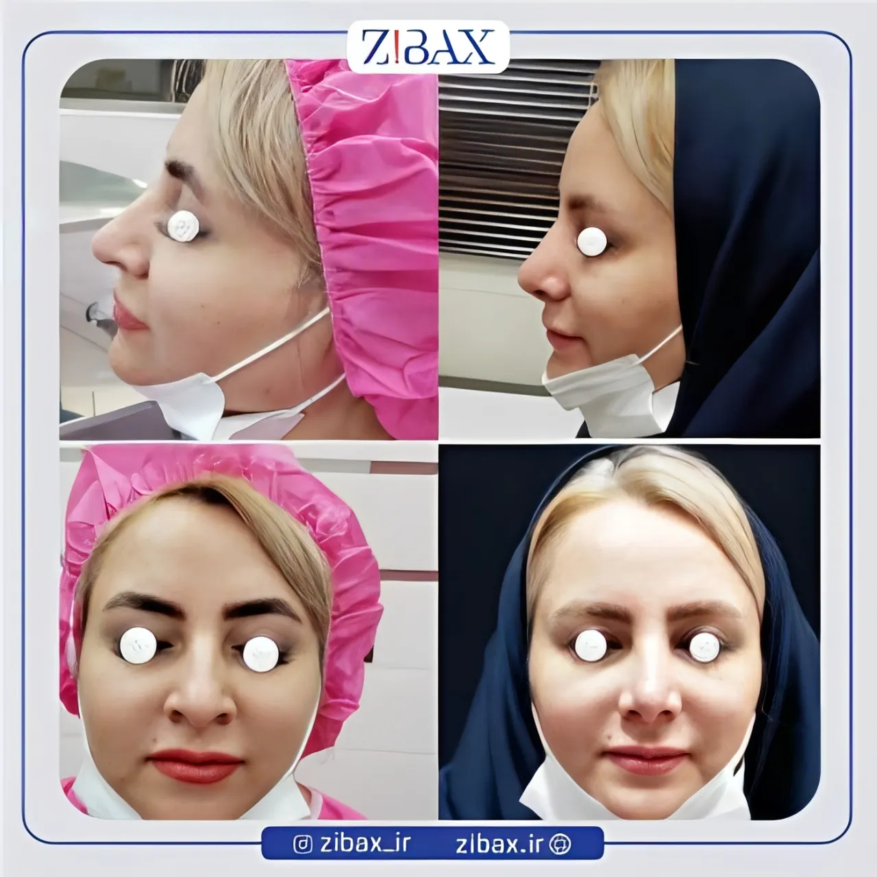 نمونه عمل جراحی بینی دکتر حسن فیروزی — تصویر 4