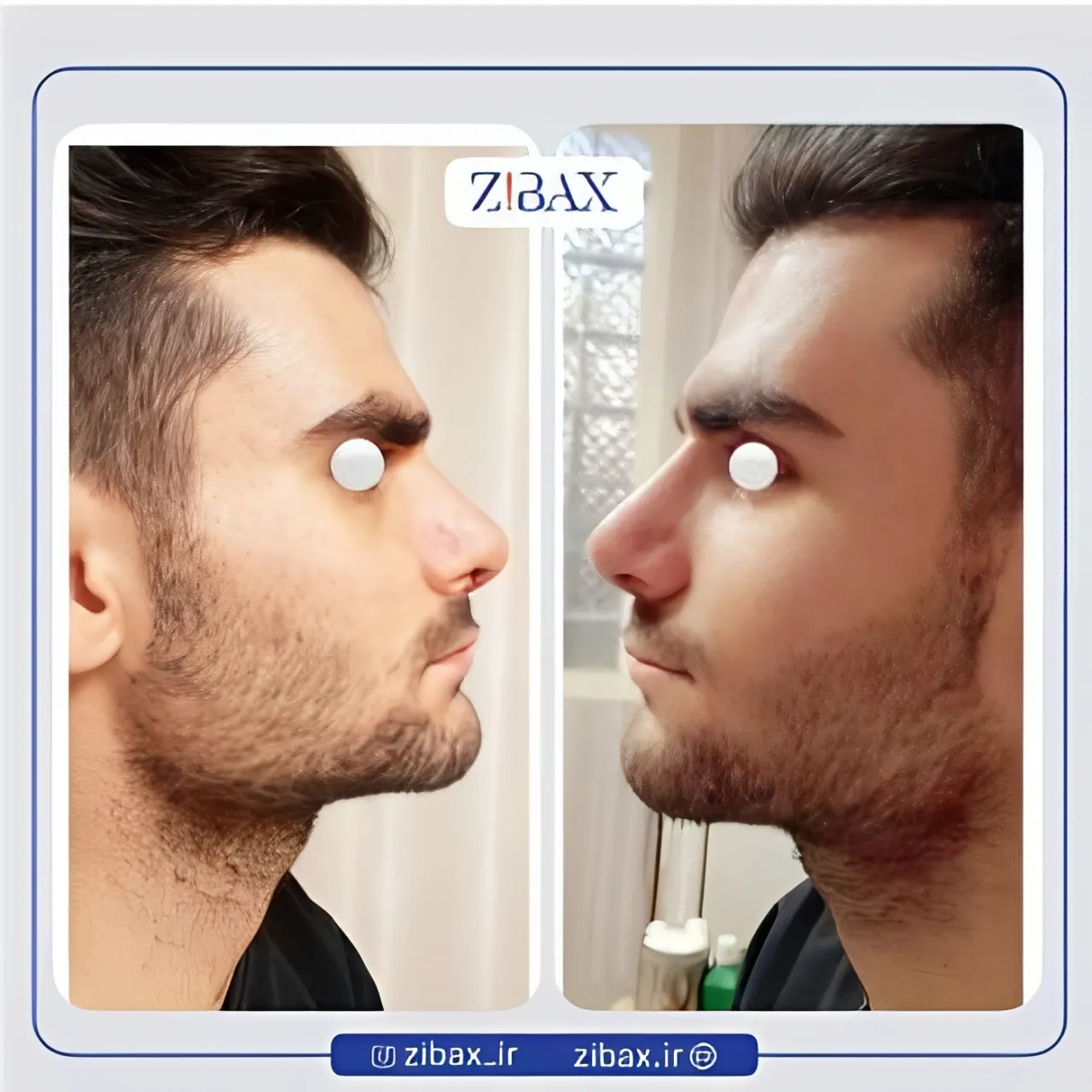 نمونه عمل جراحی بینی دکتر حسن فیروزی — تصویر 5
