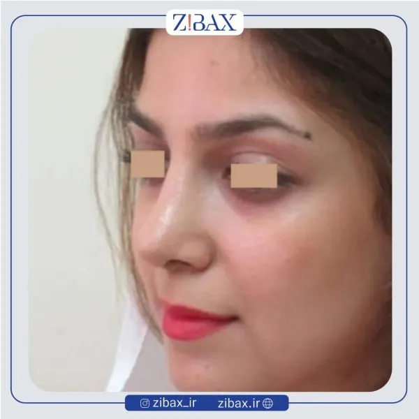 نمونه عمل جراحی بینی دکتر سید ابوالحسن جزایری — تصویر 3