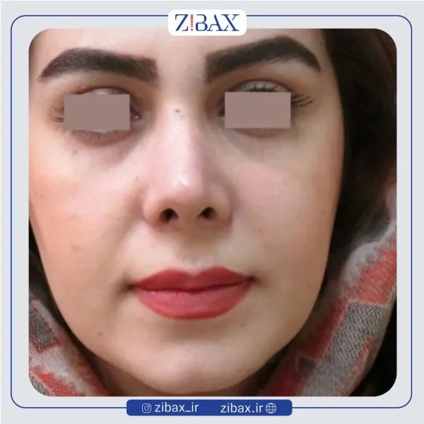 نمونه عمل جراحی بینی دکتر سید ابوالحسن جزایری — تصویر 4