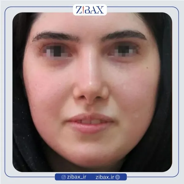 نمونه عمل جراحی بینی دکتر سید ابوالحسن جزایری — تصویر 10