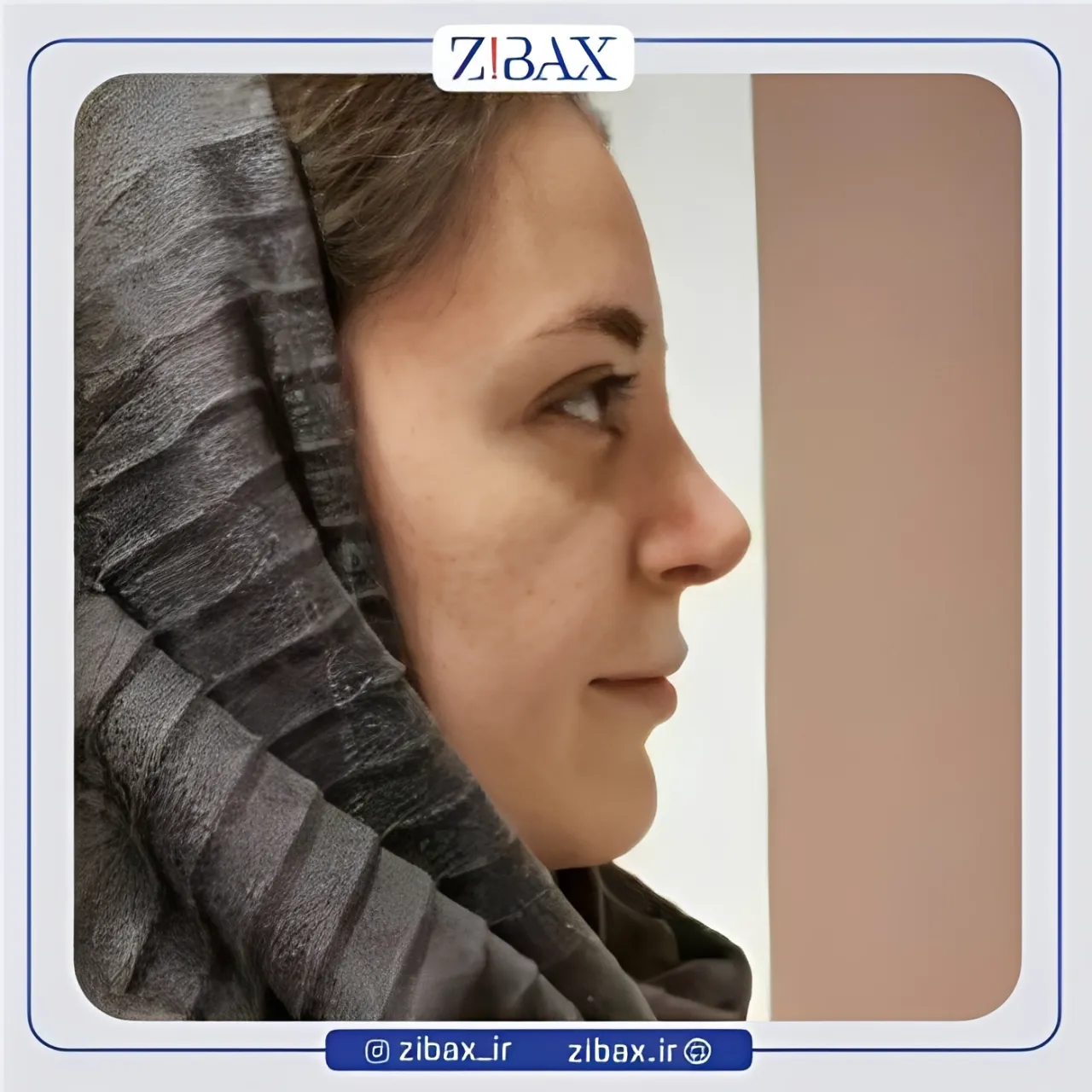 نمونه عمل جراحی بینی دکتر مجید جلالی — تصویر 2