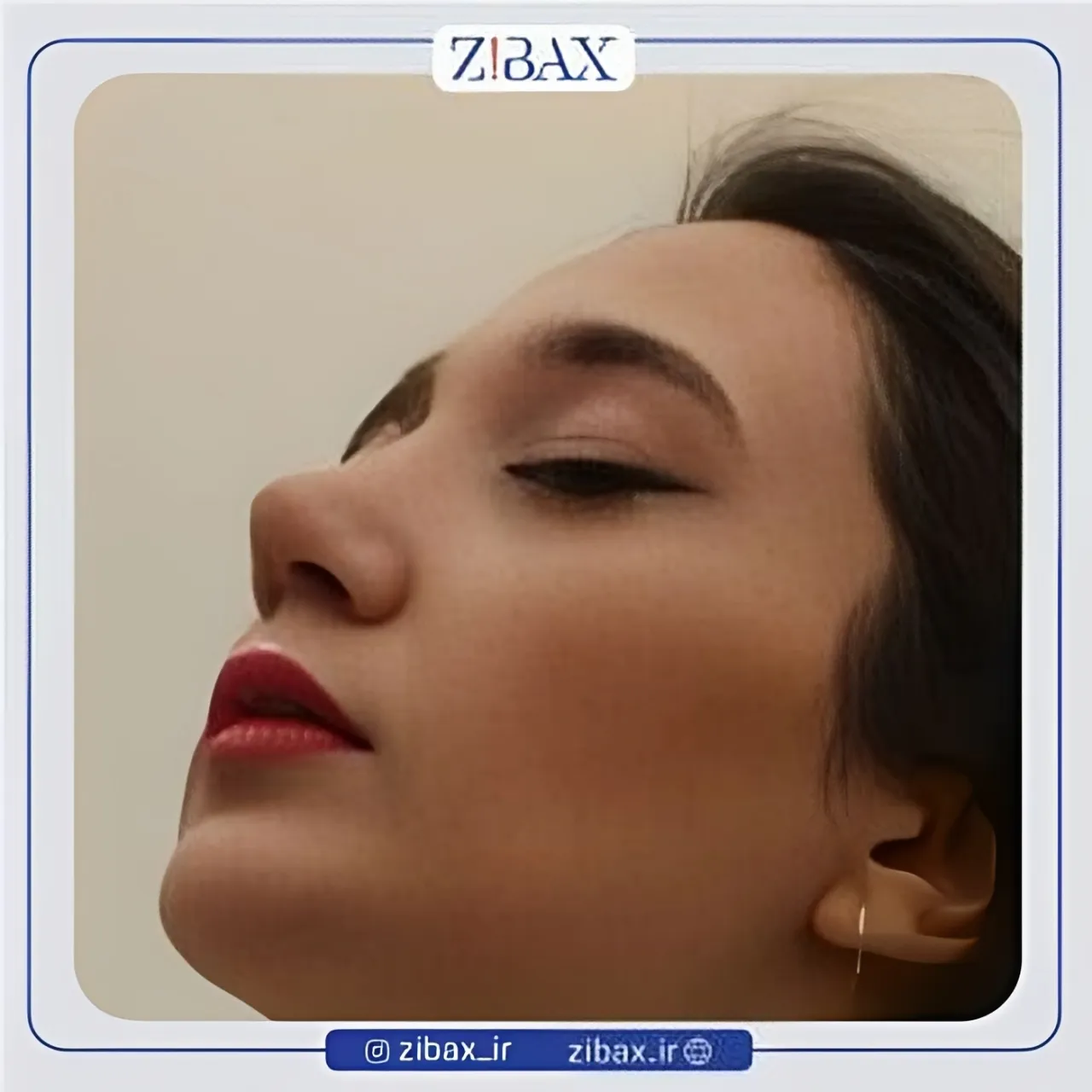 نمونه عمل جراحی بینی دکتر مجید جلالی — تصویر 5