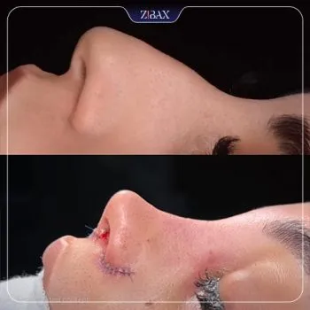 نمونه عمل جراحی بینی دکتر مسعود جانی پور — تصویر 8