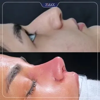 نمونه عمل جراحی بینی دکتر مسعود جانی پور — تصویر 6