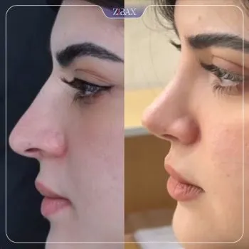 نمونه عمل جراحی بینی دکتر مسعود جانی پور — تصویر 5
