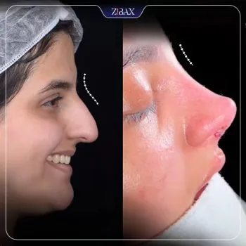 نمونه عمل جراحی بینی دکتر مسعود جانی پور — تصویر 2