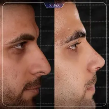 نمونه عمل جراحی بینی دکتر مسعود جانی پور — تصویر 1