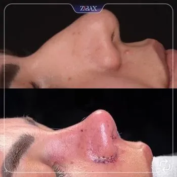 نمونه عمل جراحی بینی دکتر مسعود جانی پور — تصویر 10