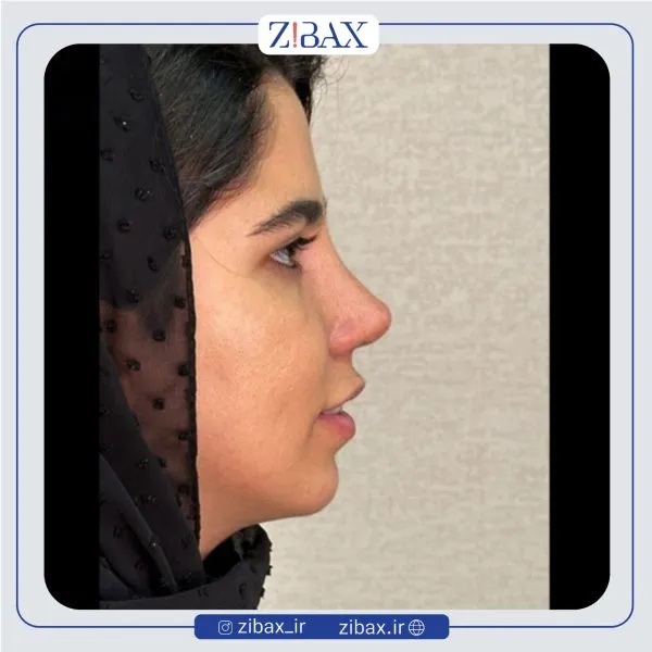 نمونه عمل جراحی بینی دکتر مهدی صباغی — تصویر 1