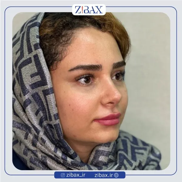 نمونه عمل جراحی بینی دکتر مهدی صباغی — تصویر 2
