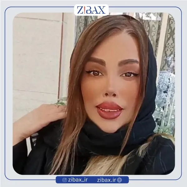 نمونه عمل جراحی بینی دکتر مهدی صباغی — تصویر 4