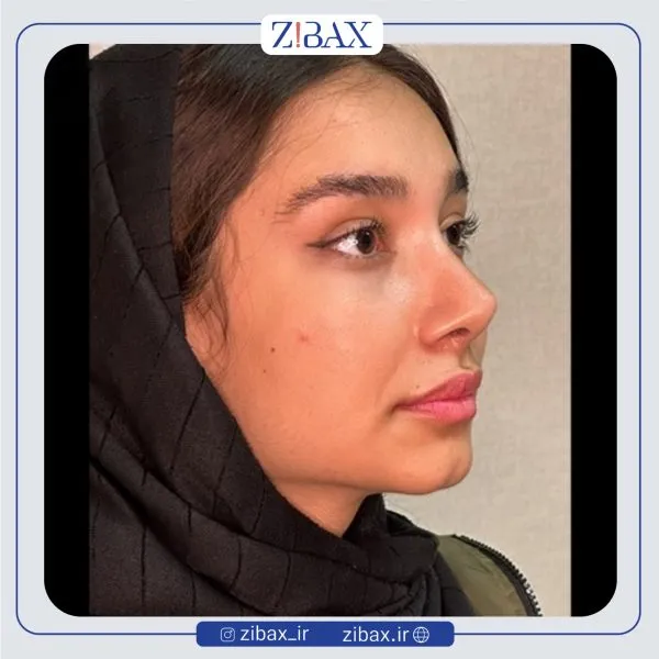 نمونه عمل جراحی بینی دکتر مهدی صباغی — تصویر 7