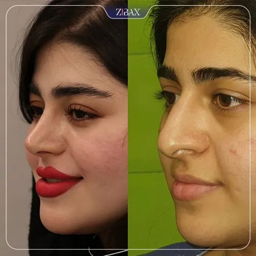 نمونه عمل جراحی بینی دکتر نصیر سعیدی — تصویر 6