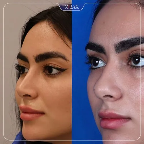 نمونه عمل جراحی بینی دکتر نصیر سعیدی — تصویر 7