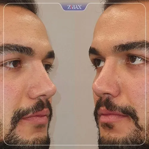نمونه عمل جراحی بینی دکتر نصیر سعیدی — تصویر 8