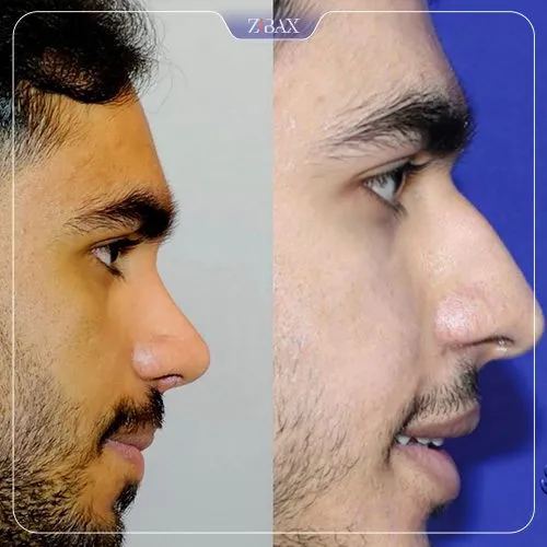 نمونه عمل جراحی بینی دکتر نصیر سعیدی — تصویر 9
