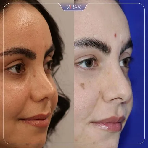 نمونه عمل جراحی بینی دکتر نصیر سعیدی — تصویر 2