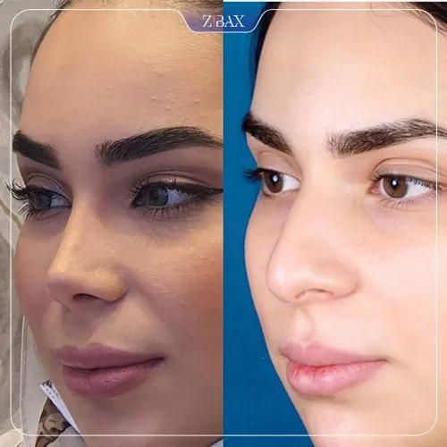 نمونه عمل جراحی بینی دکتر نصیر سعیدی — تصویر 4