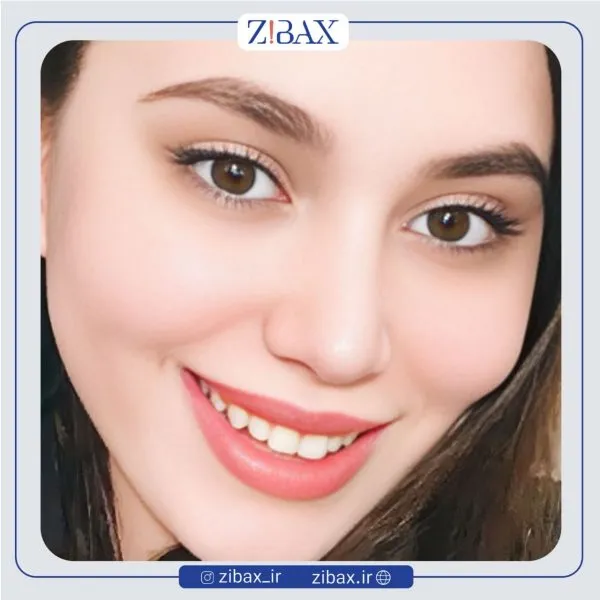 نمونه عمل جراحی بینی دکتر پوپک ایزدی — تصویر 2