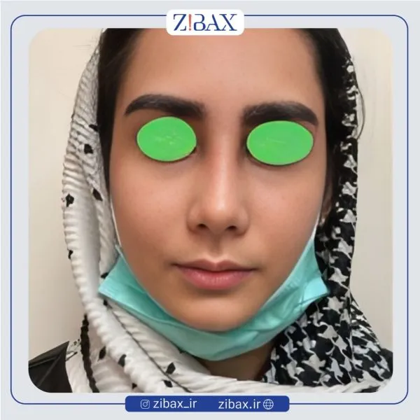 نمونه عمل جراحی بینی دکتر پوپک ایزدی — تصویر 3