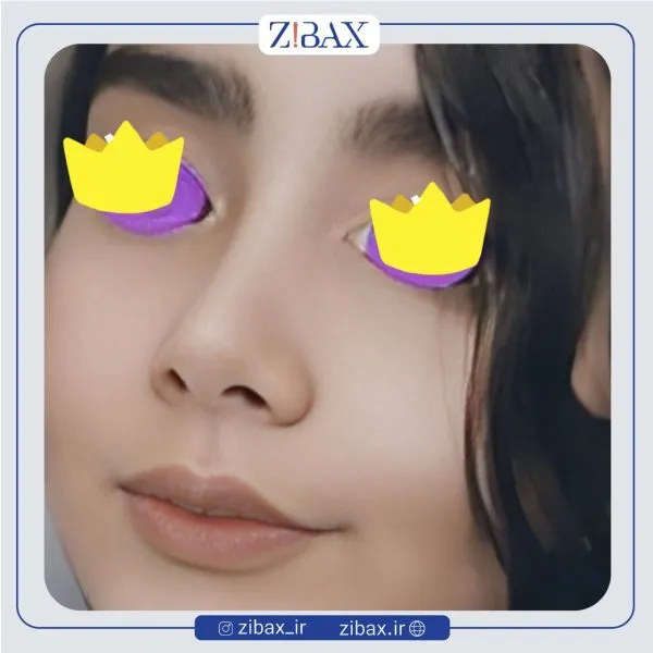 نمونه عمل جراحی بینی دکتر پوپک ایزدی — تصویر 4