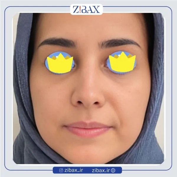 نمونه عمل جراحی بینی دکتر پوپک ایزدی — تصویر 5