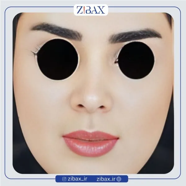 نمونه عمل جراحی بینی دکتر پوپک ایزدی — تصویر 7