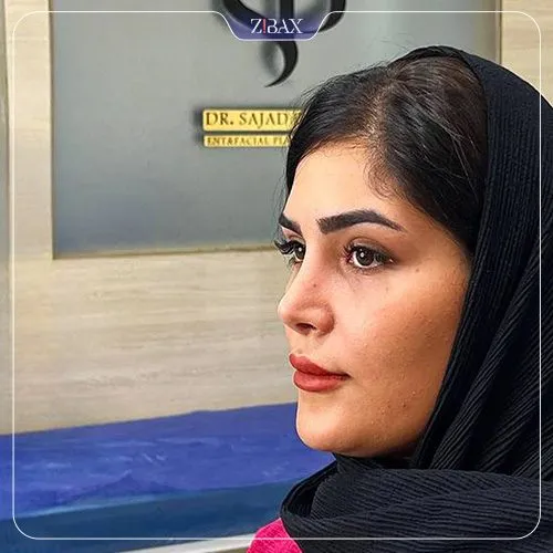 نمونه عمل جراحی بینی دکتر سجاد پیشگر — تصویر 4