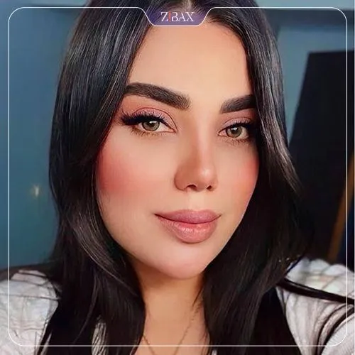 نمونه عمل جراحی بینی دکتر سجاد پیشگر — تصویر 5