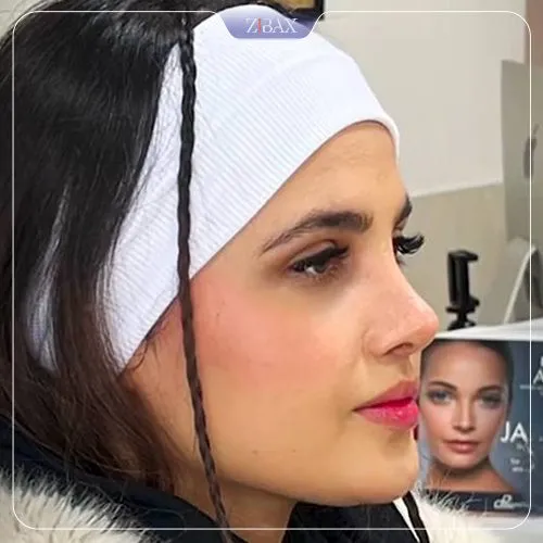 نمونه عمل جراحی بینی دکتر سجاد پیشگر — تصویر 7