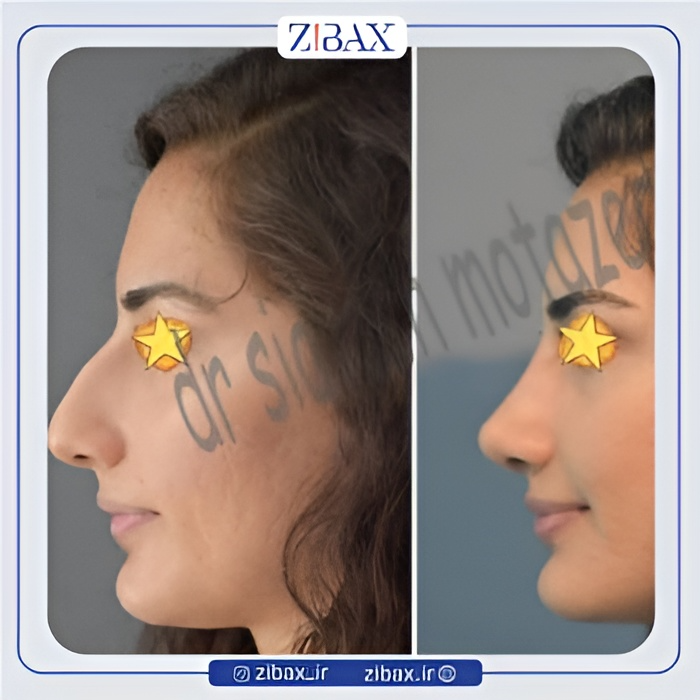نمونه عمل جراحی بینی دکتر سیاوش معتضدیان — تصویر 1