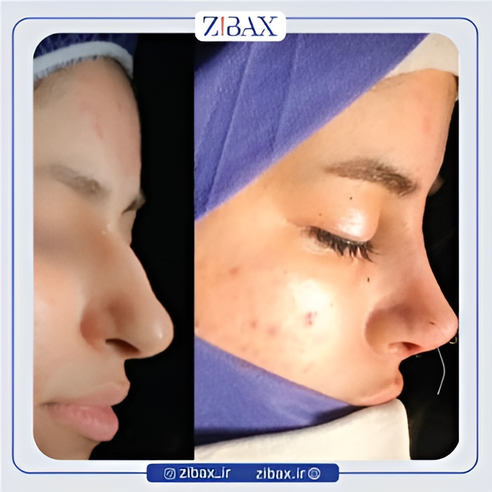 نمونه عمل جراحی بینی دکتر سیاوش معتضدیان — تصویر 10
